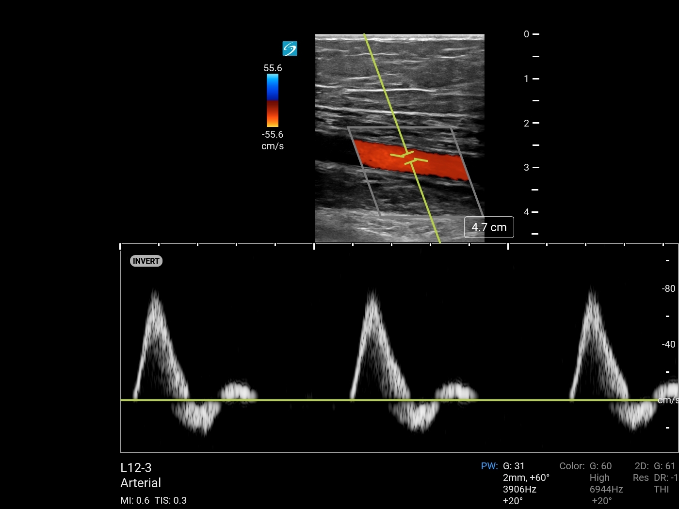 Doppler De Potencia En Color Imagen Sonosite Institute For Point Of Care Ultrasound